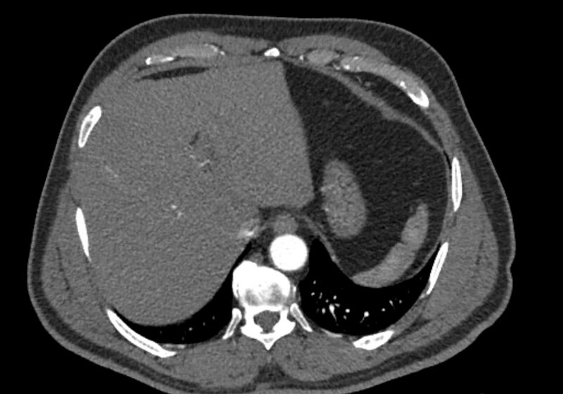 File:Celiac artery dissection (Radiopaedia 52194-58080 A 5).jpg