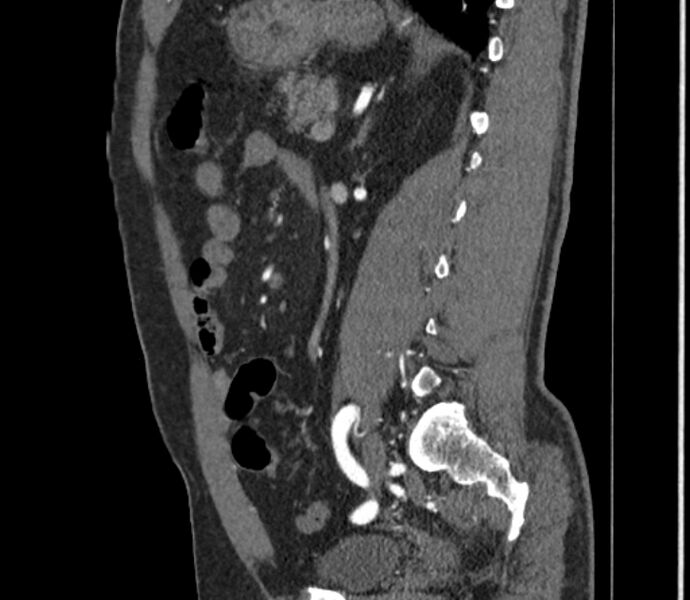 File:Celiac artery dissection (Radiopaedia 52194-58080 B 94).jpg