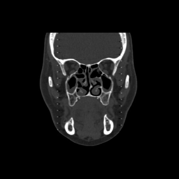 File:Cemento-ossifying fibroma (Radiopaedia 21243-21149 Coronal bone window 10).jpg