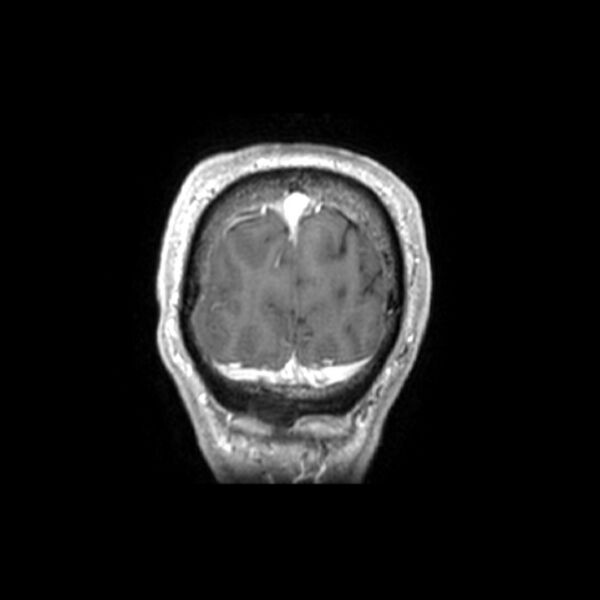 File:Central neurocytoma (Radiopaedia 67618-77021 Coronal T1 C+ 1).jpg