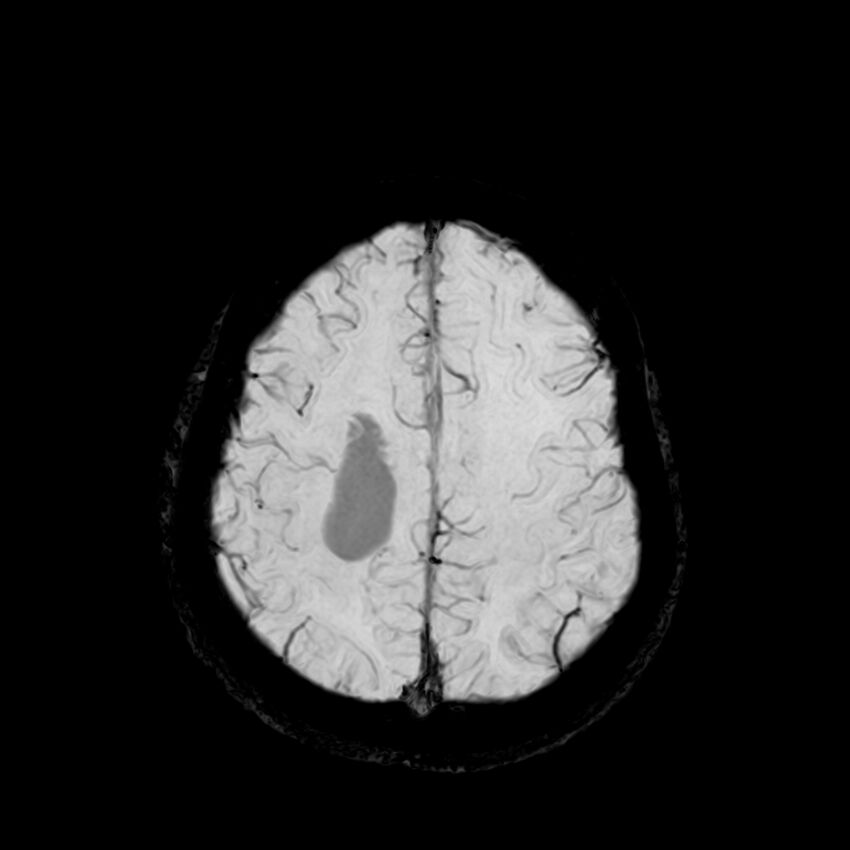 Central neurocytoma (Radiopaedia 79320-92380 Axial SWI 110).jpg