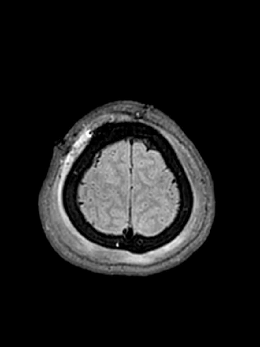 Central neurocytoma (Radiopaedia 79320-92381 Axial FLAIR 33).jpg
