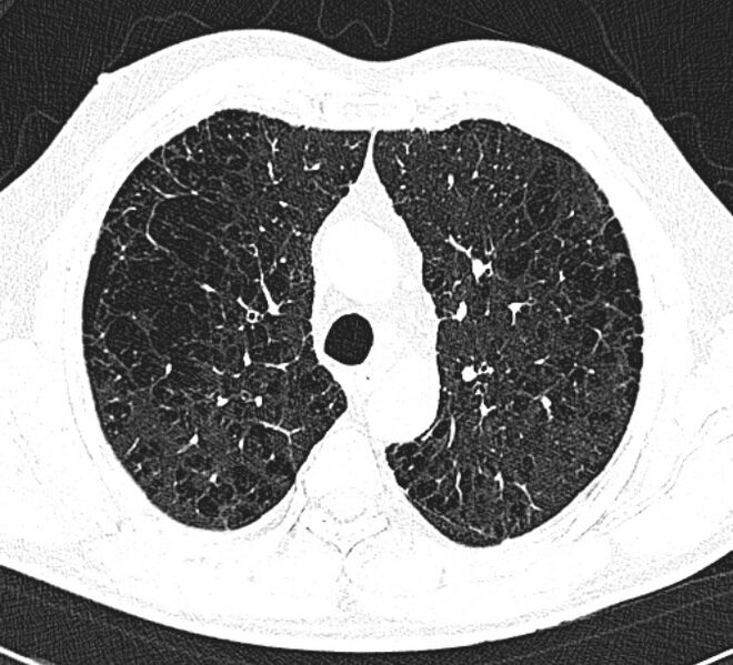 File:Centrilobular pulmonary emphysema (Radiopaedia 26808-26971 Axial lung window 13).jpg