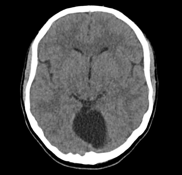 File:Cerebellar agenesis (Radiopaedia 30203-30817 Axial non-contrast 18).jpg