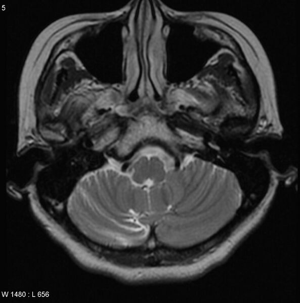 File:Cerebellar arteriovenous malformation (Radiopaedia 5220-6988 Axial T2 1).jpg