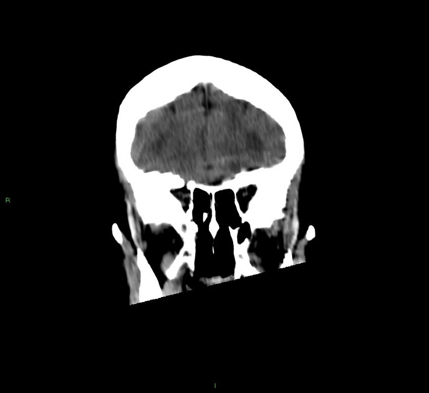 Cerebellar hemorrhage (Radiopaedia 58792-66026 Coronal non-contrast 48).jpg