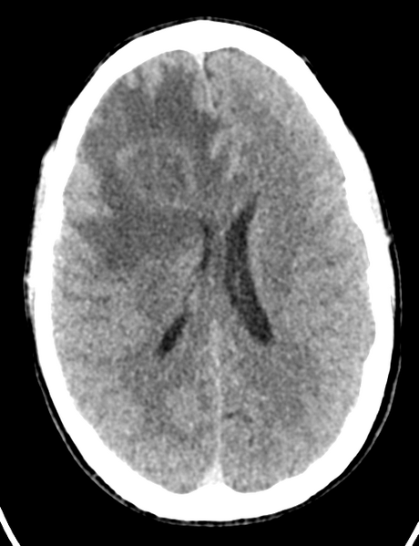File:Cerebral abscess (Radiopaedia 60342-68008 Axial non-contrast 32).png