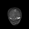 Cerebral abscess post cardiac surgery (Radiopaedia 27244-27420 Coronal T1 C+ 22).jpg