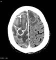 Cerebral abscesses secondary to contusions (Radiopaedia 5201-6967 Axial C+ delayed 9).jpg