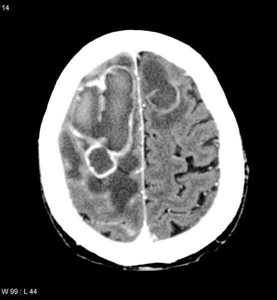 File:Cerebral abscesses secondary to contusions (Radiopaedia 5201-6967 Axial C+ delayed 9).jpg