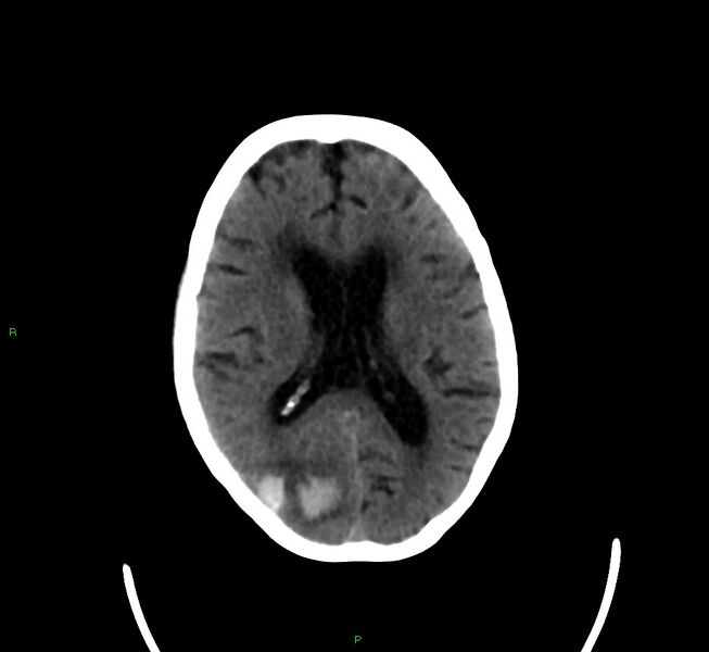File:Cerebral amyloid angiopathy-associated lobar intracerebral hemorrhage (Radiopaedia 58377-65514 Axial non-contrast 22).jpg