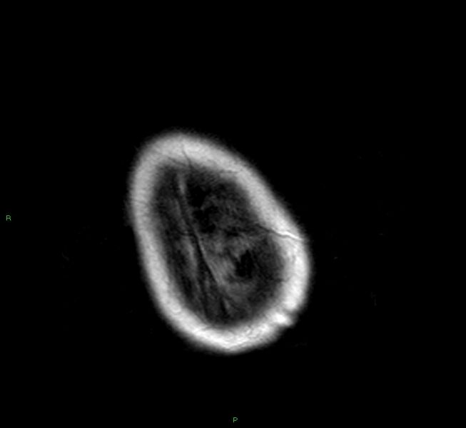File:Cerebral amyloid angiopathy-associated lobar intracerebral hemorrhage (Radiopaedia 58377-65515 Axial FLAIR 3).jpg