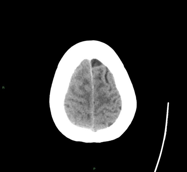 File:Cerebral amyloid angiopathy-associated lobar intracerebral hemorrhage (Radiopaedia 58563-65727 Axial non-contrast 11).jpg