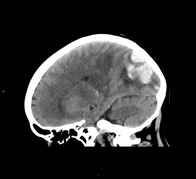 File:Cerebral amyloid angiopathy-associated lobar intracerebral hemorrhage (Radiopaedia 58563-65727 C 23).jpg
