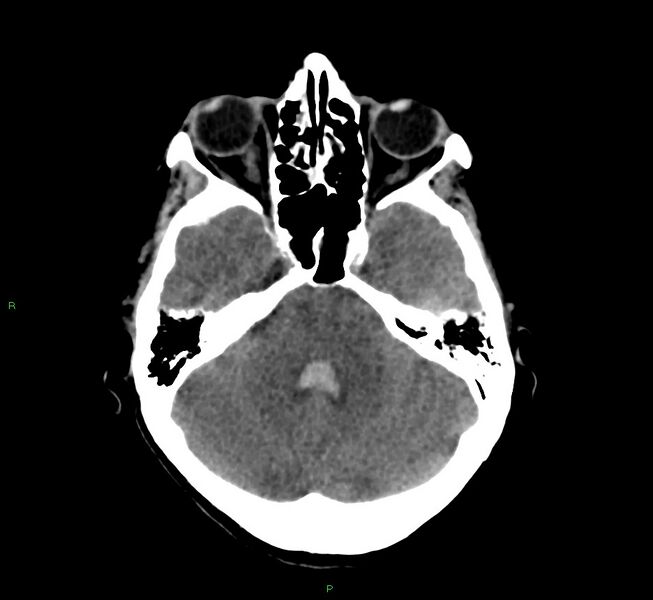 File:Cerebral amyloid angiopathy-associated lobar intracerebral hemorrhage (Radiopaedia 58566-65730 Axial non-contrast 37).jpg