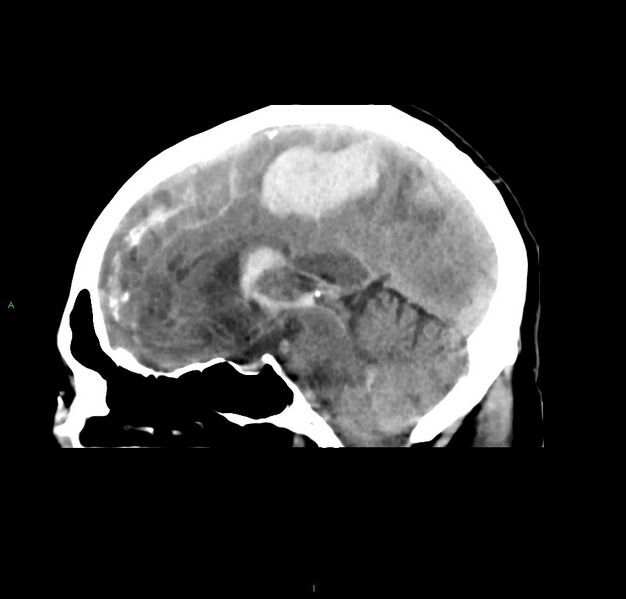 File:Cerebral amyloid angiopathy-associated lobar intracerebral hemorrhage (Radiopaedia 59356-66716 C 29).jpg