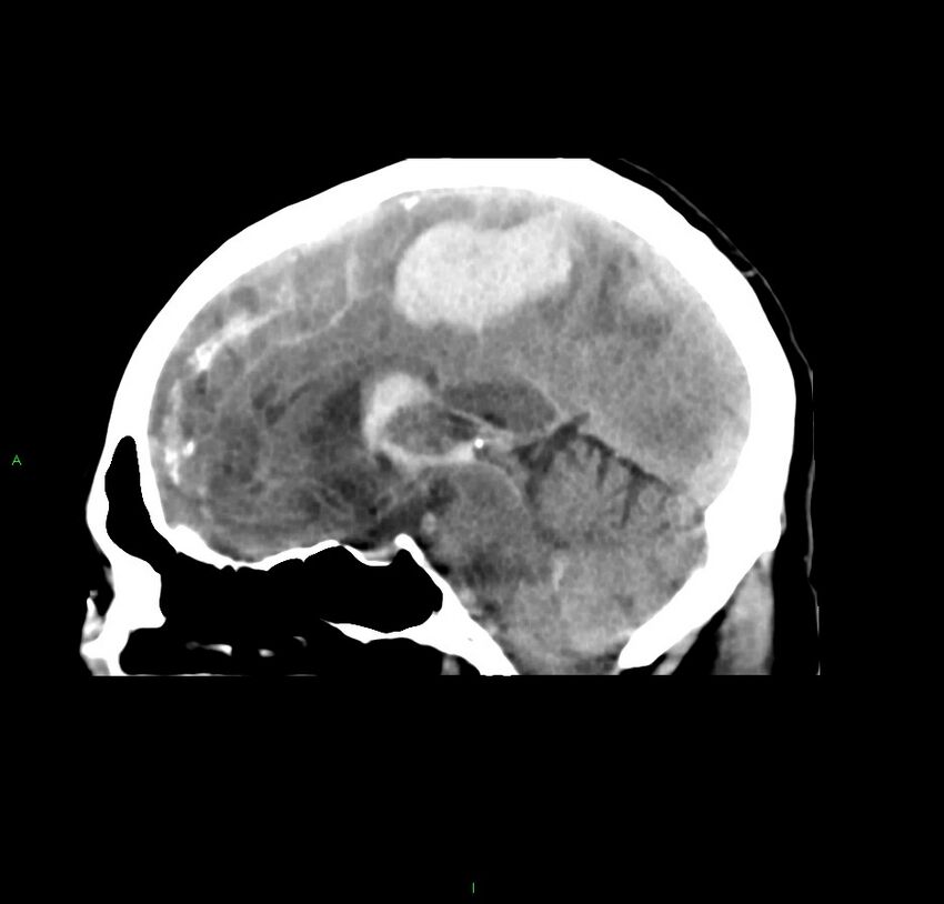 Cerebral amyloid angiopathy-associated lobar intracerebral hemorrhage (Radiopaedia 59356-66716 C 29).jpg