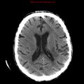 Cerebral and orbital tuberculomas (Radiopaedia 13308-13310 Axial non-contrast 17).jpg