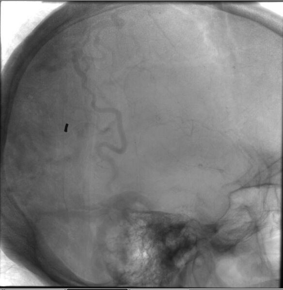 File:Cerebral arteriovenous malformation (Radiopaedia 10989-11408 D 1).jpg