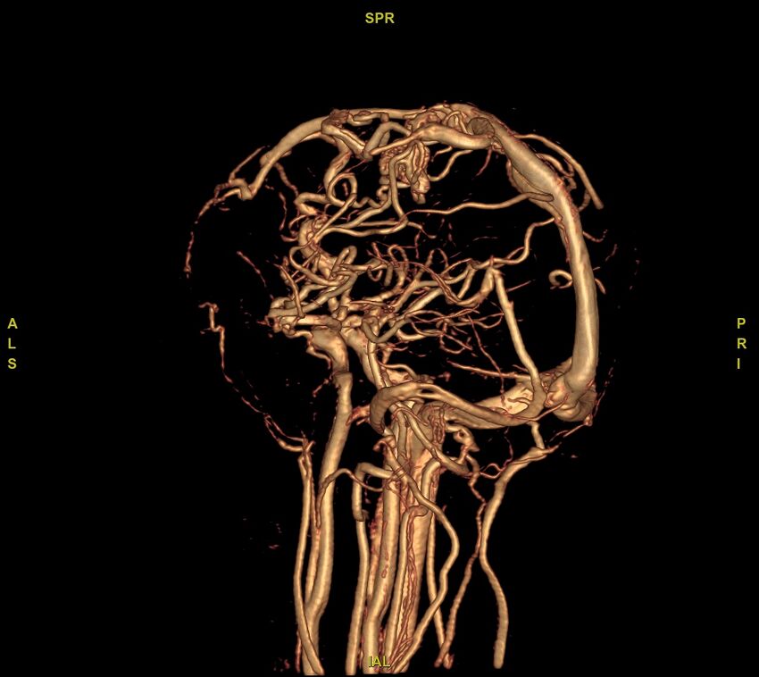 Cerebral arteriovenous malformation (Radiopaedia 61964-70029 VRT 7).jpg