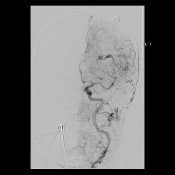 File:Cerebral arteriovenous malformation with lobar hemorrhage (Radiopaedia 44725-48513 LT CCA IC 14).png