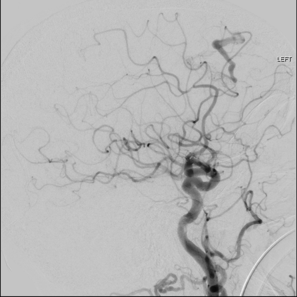 File:Cerebral arteriovenous malformation with lobar hemorrhage (Radiopaedia 44725-48513 LT CCA IC 35).png