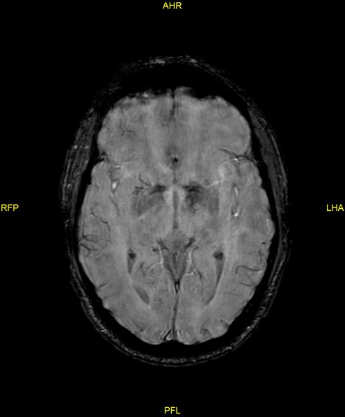 File:Cerebral autosomal dominant arteriopathy with subcortical infarcts and leukoencephalopathy (CADASIL) (Radiopaedia 86108-102054 Axial SWI 52).jpg
