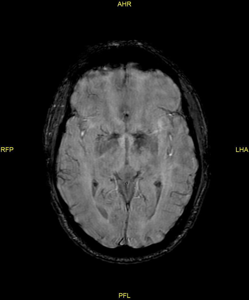 Cerebral autosomal dominant arteriopathy with subcortical infarcts and leukoencephalopathy (CADASIL) (Radiopaedia 86108-102054 Axial SWI 52).jpg