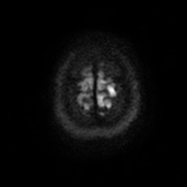 File:Cerebral cavernous malformation (Radiopaedia 44301-47942 Axial DWI 20).jpg