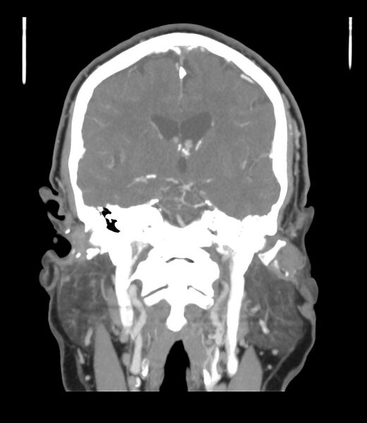 File:Cerebral dural venous sinus thrombosis (Radiopaedia 86514-102576 B 34).jpg