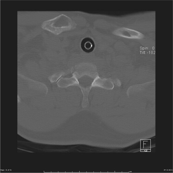 File:Cerebral hemorrhagic contusions and cervical spine fractures (Radiopaedia 32865-33841 C 31).jpg