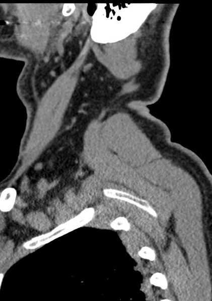 File:Cerebral hemorrhagic contusions and cervical spine fractures (Radiopaedia 32865-33841 G 100).jpg