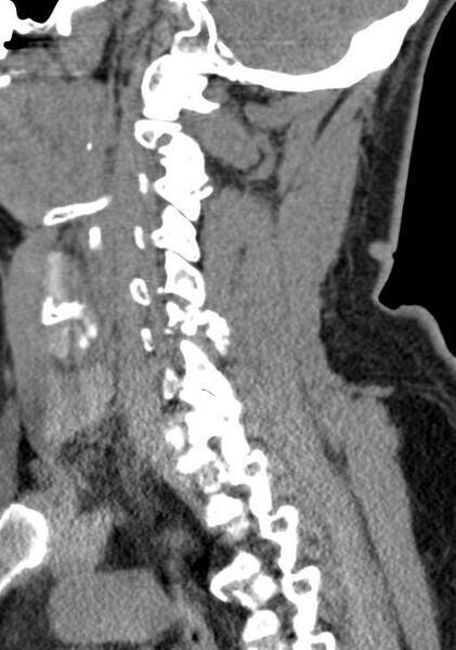 File:Cerebral hemorrhagic contusions and cervical spine fractures (Radiopaedia 32865-33841 G 46).jpg