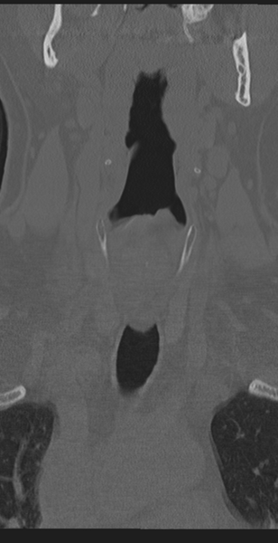 File:Cervical canal stenosis - OPLL and osteophytes (Radiopaedia 47329-51910 Coronal bone window 4).png
