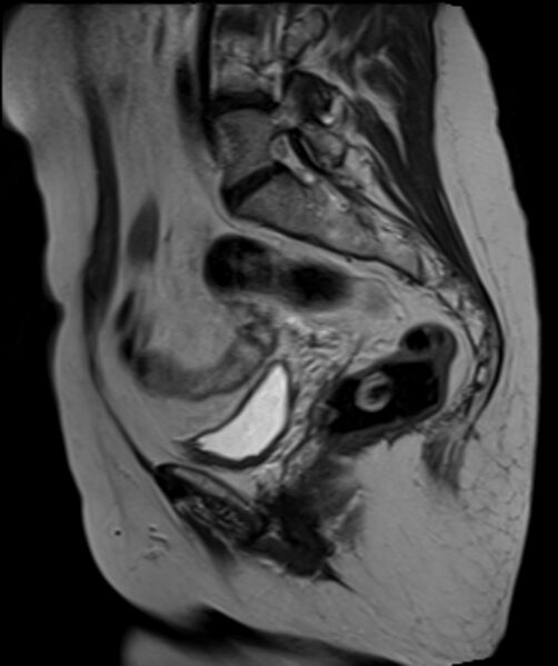 File:Cervical carcinoma (Radiopaedia 88312-104943 Sagittal T2 13).jpg