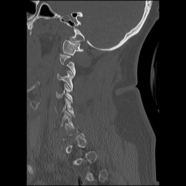 File:Cervical fracture and dislocation with locked facet (Radiopaedia 31837-32780 Sagittal bone window 5).jpg