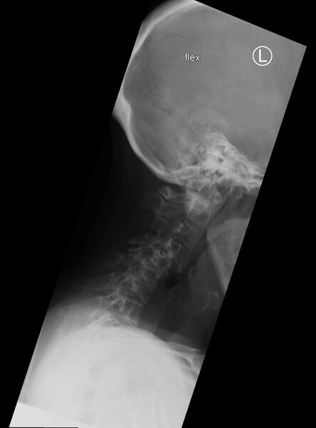 File:Cervical spine dynamic instability in patient with rheumatoid arthritis (Radiopaedia 45107-49087 Flexion 1).jpg