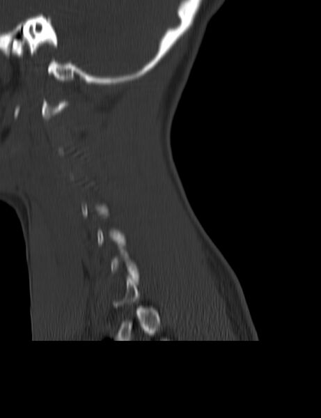 File:Cervical spine posterior ligamentous complex rupture (Radiopaedia 63486-72101 Sagittal bone window 1).jpg