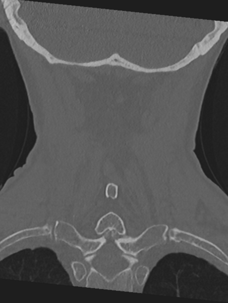 File:Cervical spondylolysis (Radiopaedia 49616-54811 Coronal bone window 46).png