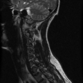 Cervical vertebrae metastasis (Radiopaedia 78814-91667 Sagittal T2 10).png