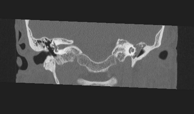 File:Cholesteatoma (Radiopaedia 10742-11203 Coronal bone window 10).jpg