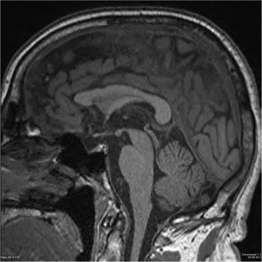 Chondrosarcoma of skull base- grade II (Radiopaedia 40948-43654 Sagittal T1 11).jpg