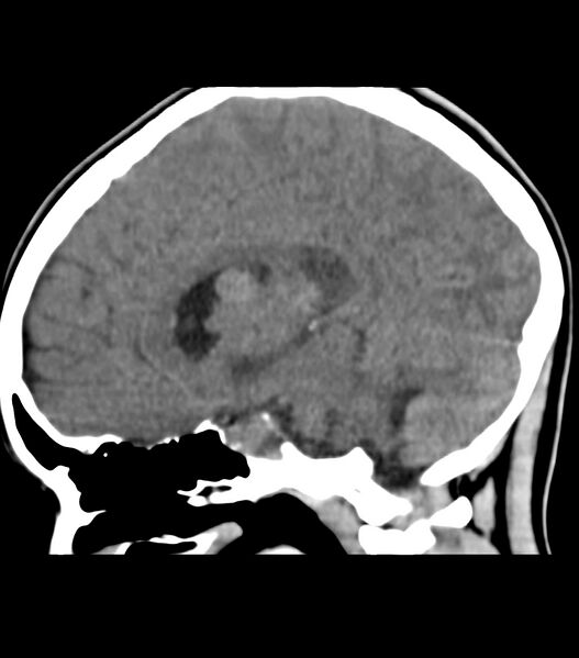 File:Choroid plexus carcinoma (Radiopaedia 91013-108552 B 33).jpg