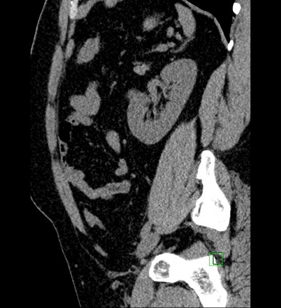 File:Chromophobe renal cell carcinoma (Radiopaedia 84286-99573 C 52).jpg