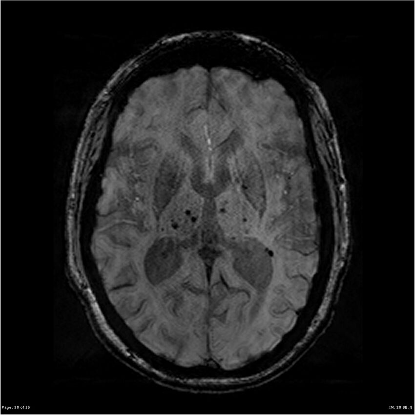 Chronic hypertensive encephalopathy (Radiopaedia 25764-25918 Axial SWI 28).jpg