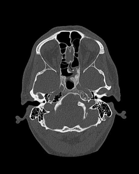 File:Chronic maxillary sinusitis caused by a foreign body (Radiopaedia 58521-65676 Axial bone window 225).jpg