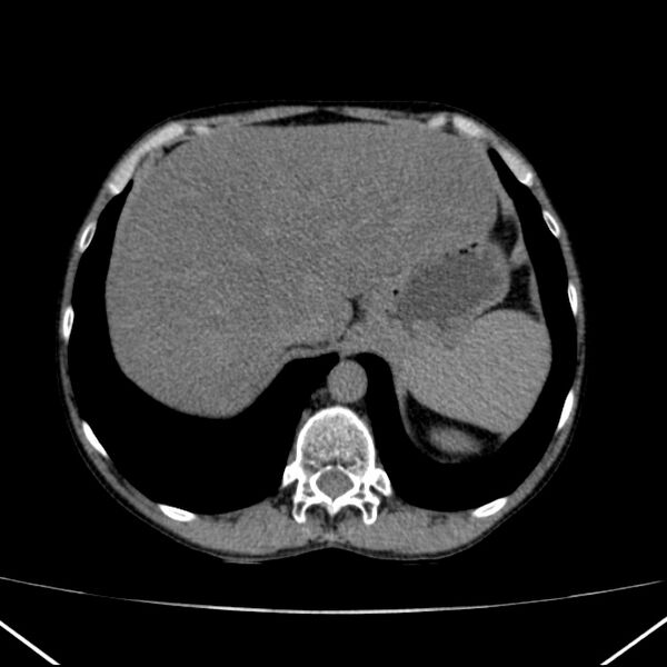 File:Chronic pancreatitis (Radiopaedia 23132-23172 Axial non-contrast 14).jpg
