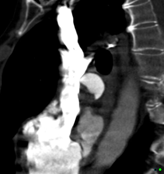 File:Chronic pulmonary embolism (Radiopaedia 17943-17702 Sagittal C+ CTPA 15).jpg