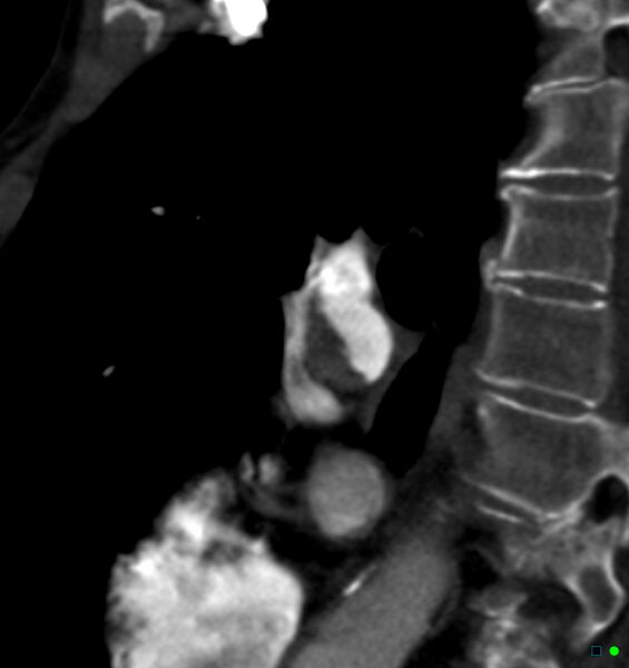 File:Chronic pulmonary embolism (Radiopaedia 17943-17702 Sagittal C+ CTPA 37).jpg