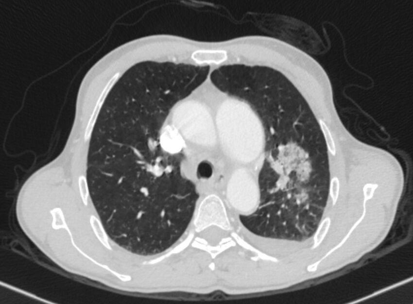 Chronic pulmonary embolism with bubbly consolidation (Radiopaedia 91248-108850 Axial lung window 51).jpg